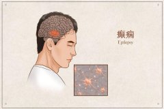 預(yù)防癲癇發(fā)作的護理措施